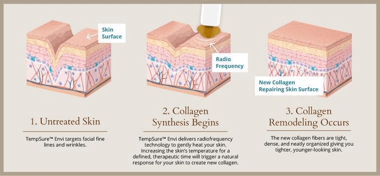 Tempsure Skin DIagram
